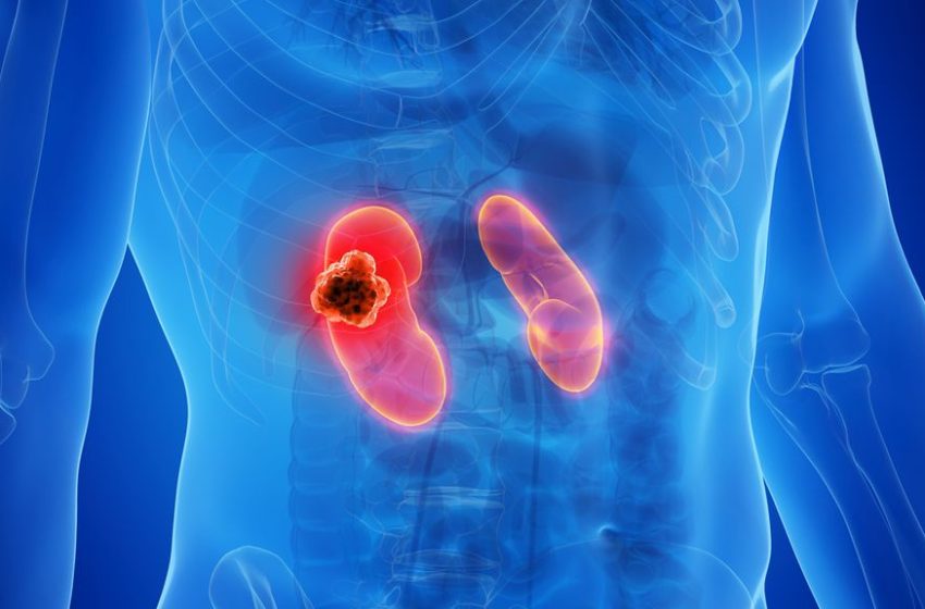 19 de junio (tercer jueves), Día Mundial del Cáncer de Riñón