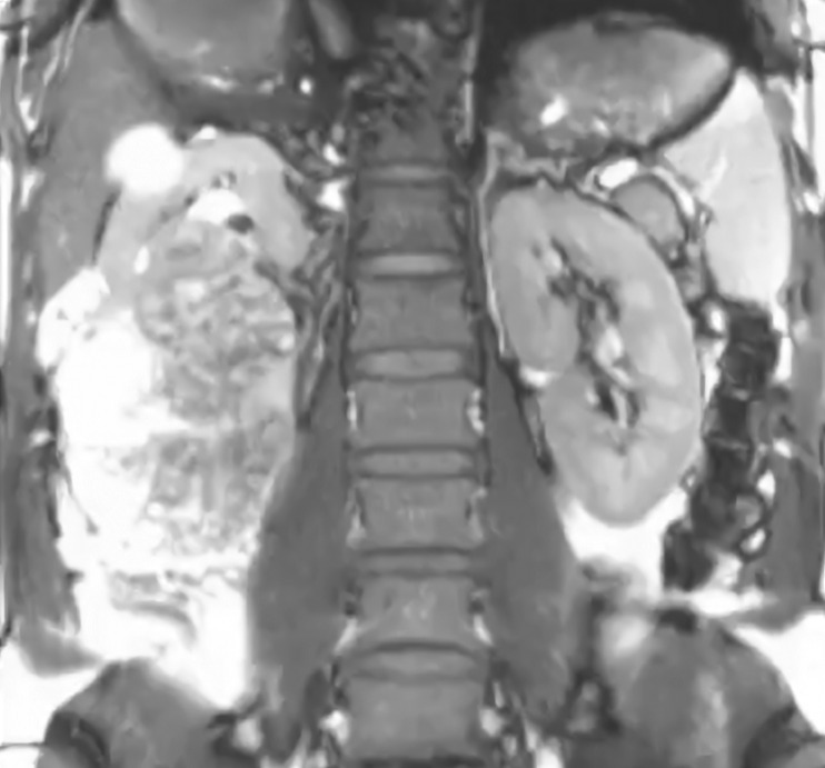Recomienda ISSSTE cuidar la salud renal para prevenir cáncer 3 ISSSTE 4 1