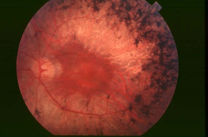 Dia retinosis pigmentaria