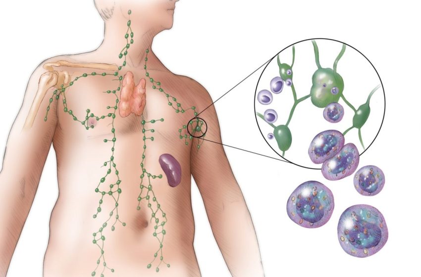 DiaLinfoma