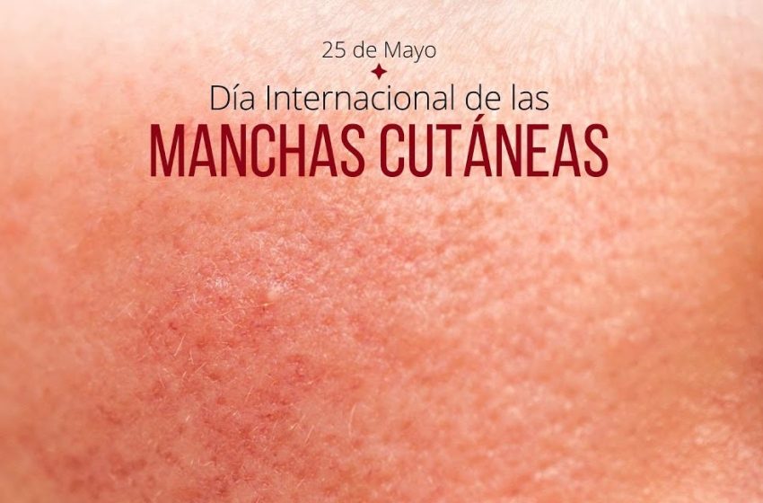  25 de mayo: Día Internacional de las Manchas Cutáneas