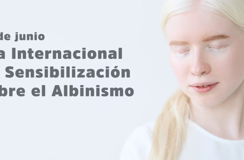 13 de junio: Día Internacional de Sensibilización sobre el Albinismo