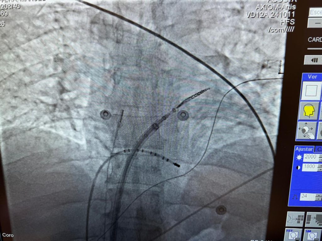 Realiza HRAE “Tlajomulco de Zúñiga” del ISSSTE en Jalisco su primera jornada de hemodinamia del año 3 FOTO 2